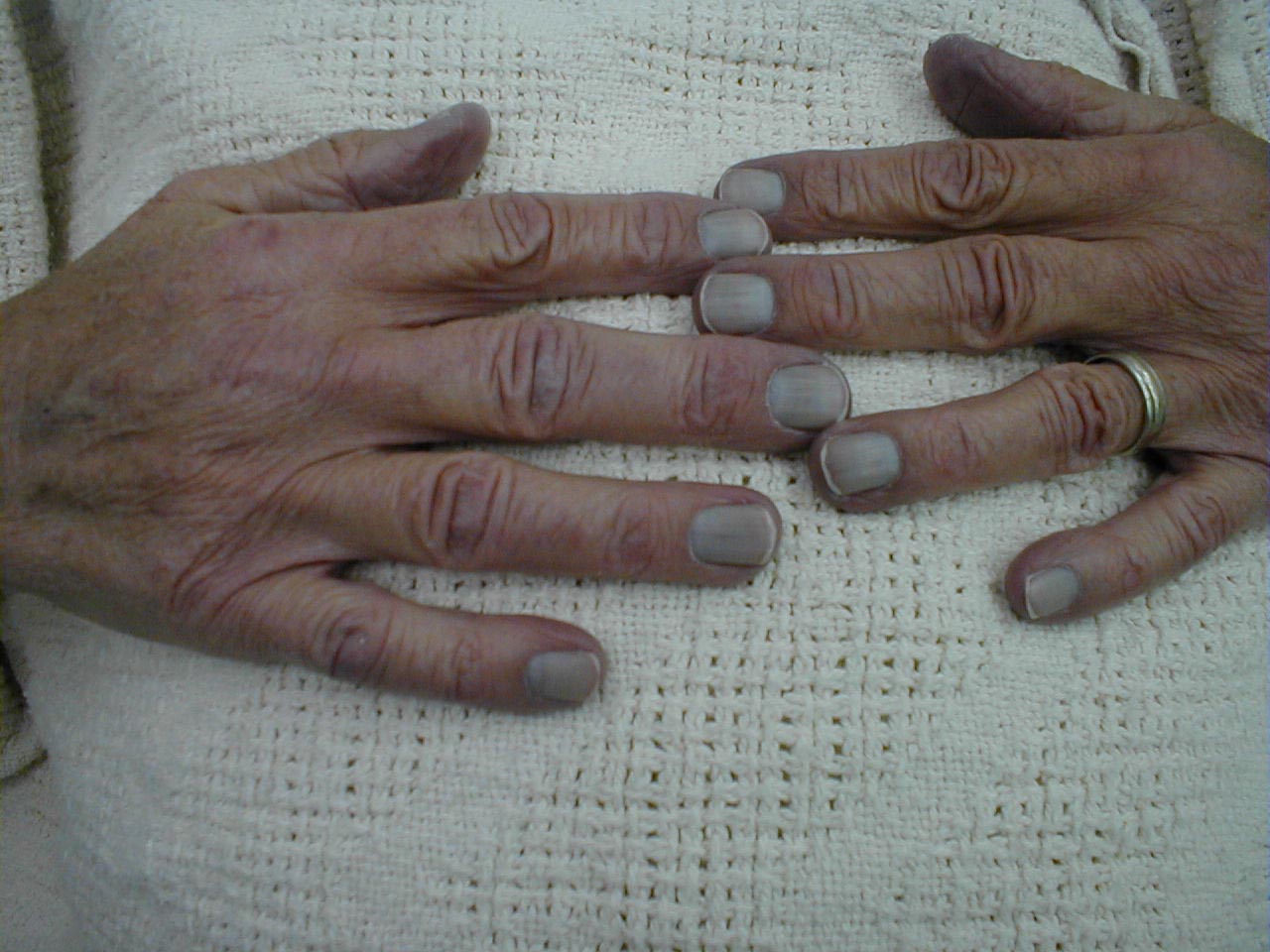 medical cyanosis2