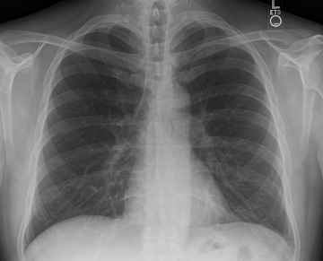 Can You Answer These Basic Nursing Questions? Chest_Xray
