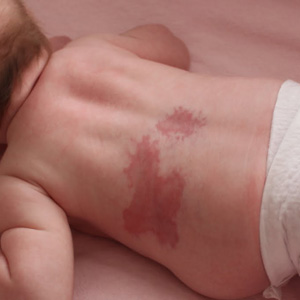 How Much Useless General Knowledge Do You Actually Have? A birthmark