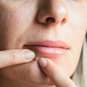 Are You Smarter Than a “Jeopardy!” Contestant? What is a pimple?