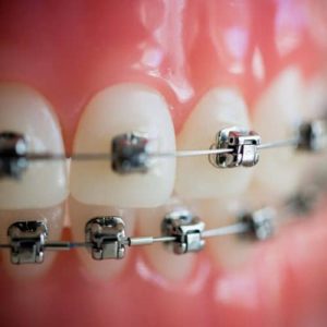 🦷 If You Score 12/15 on This Quiz, You Must Be a Dentist Braces installation