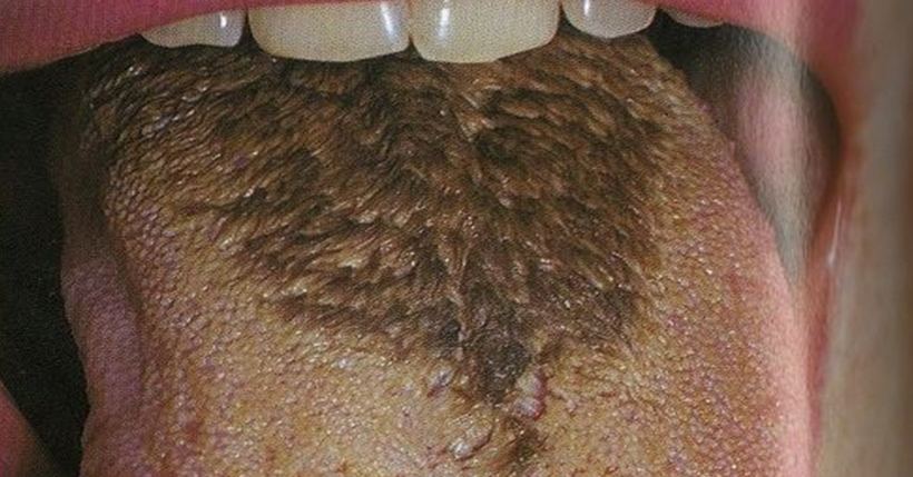 🦷 If You Score 12/15 on This Quiz, You Must Be a Dentist 15 black hairy tongue