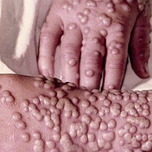 How Much Random High School Knowledge Do You Have? Smallpox