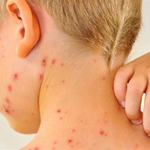 🏰 Only History Scholars Can Pass This Roman Empire Quiz Chickenpox